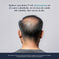 Men's Hair Regrowth