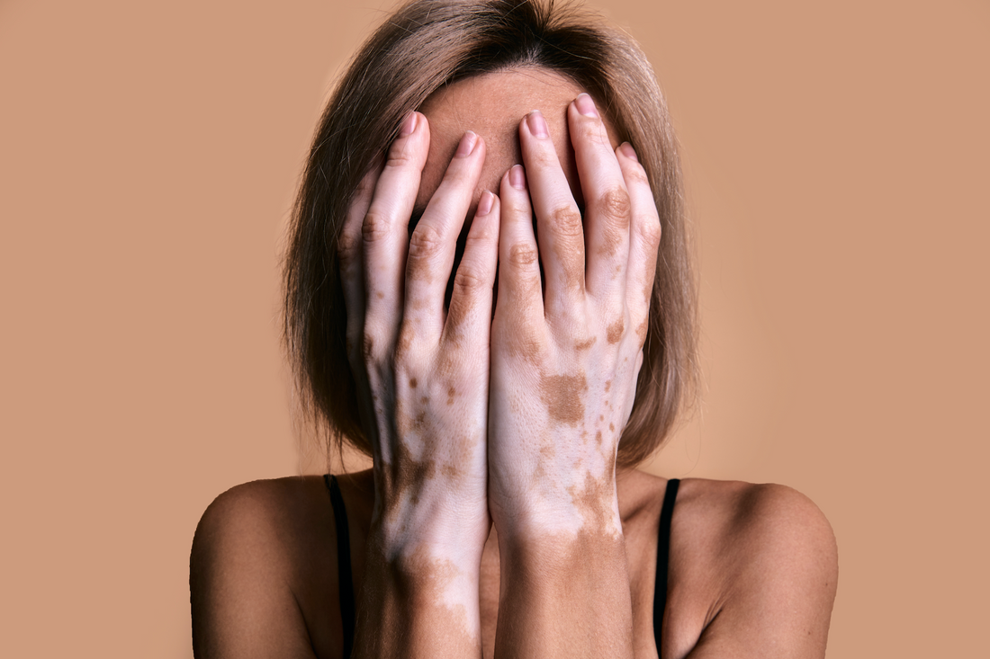 La Estrecha Relación Entre el Estrés y el Vitiligo